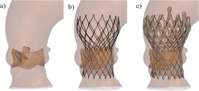 Coronary obstruction analysis in transcatheter aortic valve implantation through patient-specific computational modelling